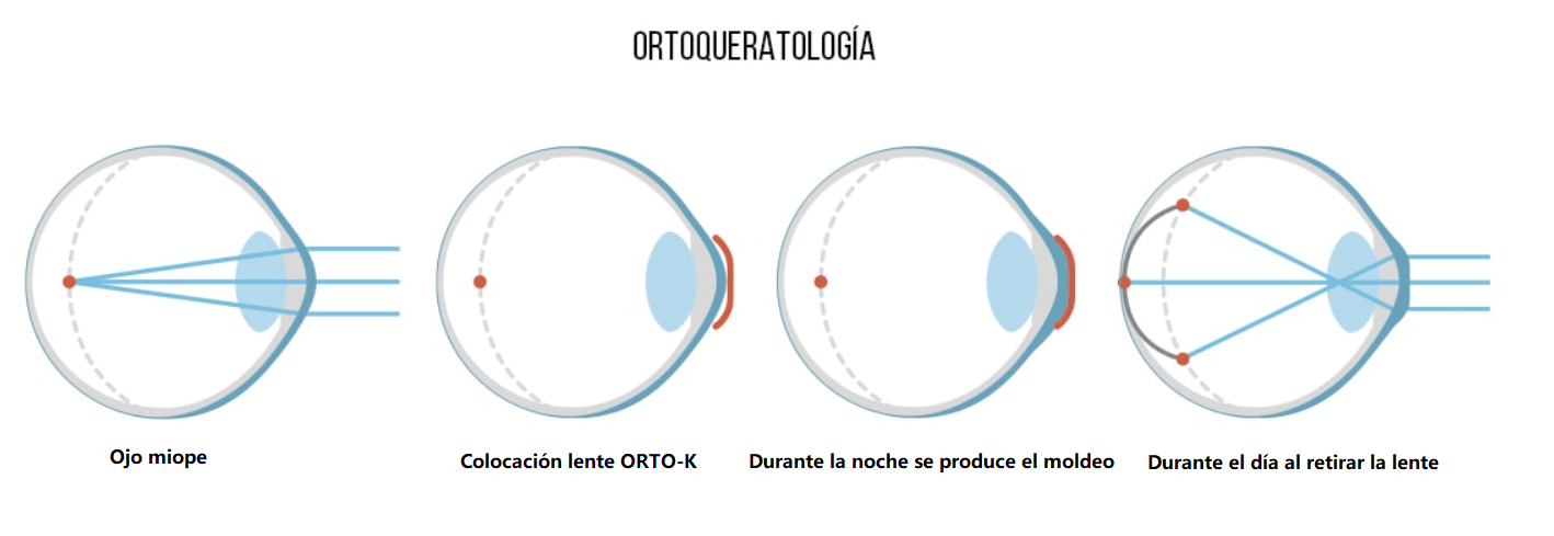 Ortoqueratología